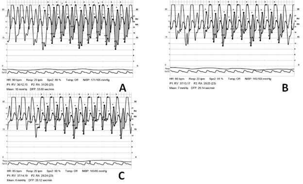 Balloon Valvuloplasty for Annular- and Leaflet-Level Tricuspid